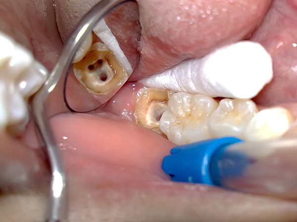 Più canali ci sono nel dente del giudizio, più costoso sarà trattare con la pulpite.