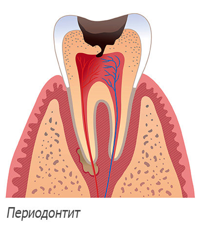 parodontite