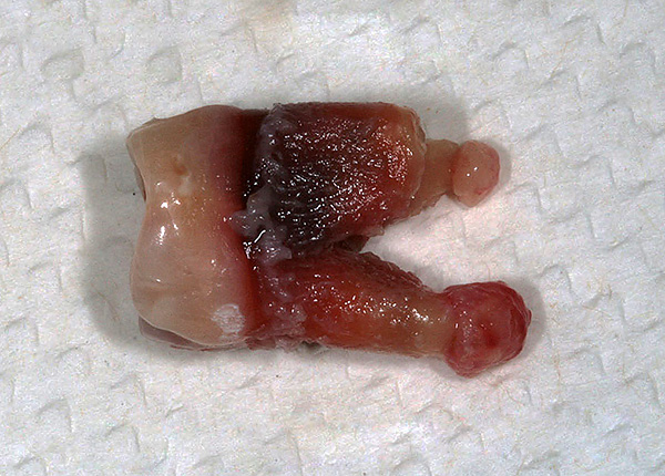 Se c'è saggezza (e qualsiasi altra) cisti sulle radici del dente, di solito viene rimosso.