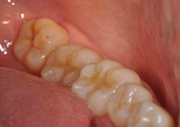 In molti casi, è consigliabile trattare la carie su un dente del giudizio piuttosto che correre per rimuovere tale dente.