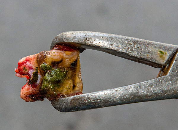 Ma marcio, per così dire, attraverso i denti della saggezza deve essere rimosso.