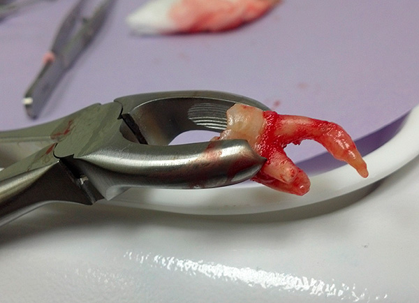 Parliamo di quanto costa oggi l'estrazione dei denti ...