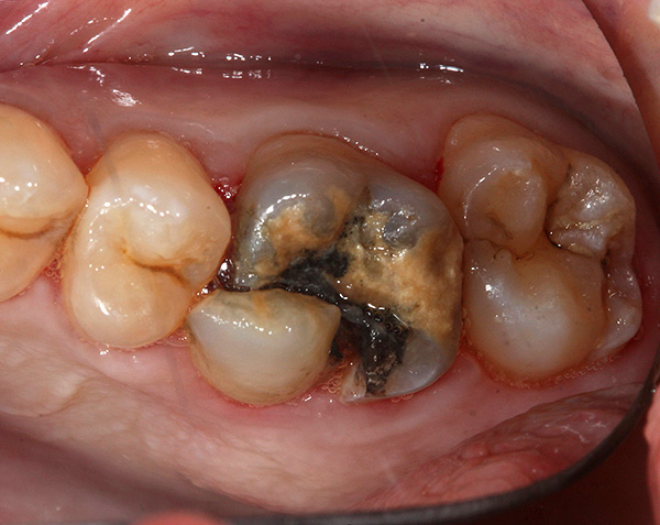 Molte persone, invece di un trattamento dentale completo, hanno fretta di strapparlo al più presto possibile, ma una tale corsa è giustificata?