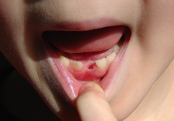 A volte è necessario rimuovere chirurgicamente i denti da latte ...