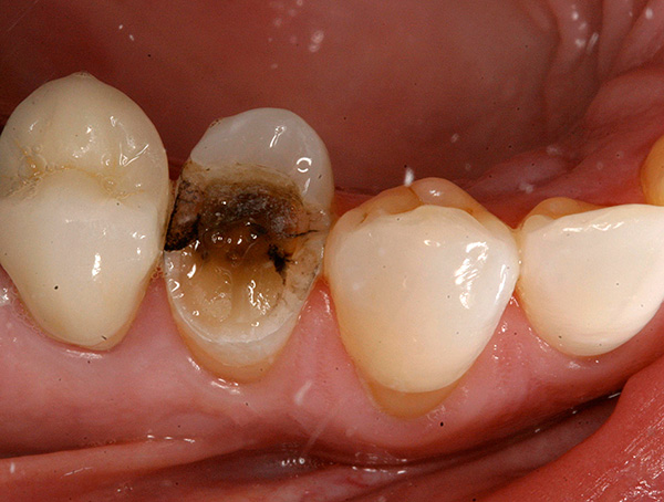 Accade spesso che quando provi ad afferrare un dente con una pinza, la sua corona, schiacciata dalla carie, si sbriciola e si rompe con uno scricchiolio.