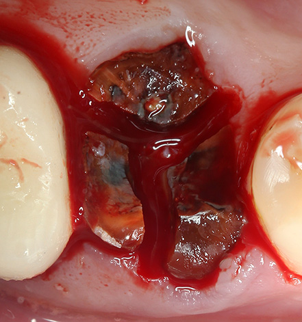 La foto mostra come appare la radice di un dente segata in tre parti con un trapano.