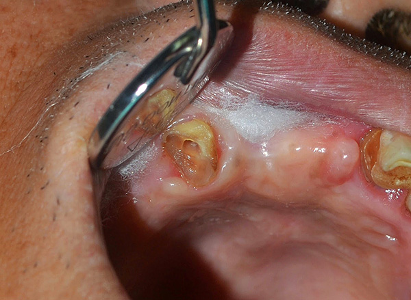 Dopo una grave distruzione della corona del dente, rimane solo la radice, che a volte può essere difficile da rimuovere.