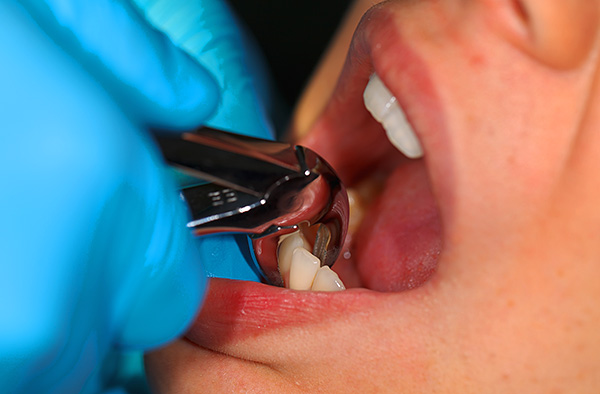 La rimozione degli incisivi, di regola, è facile, tuttavia, se il dente si rompe durante la procedura, l'estrazione della radice potrebbe non essere più facile.