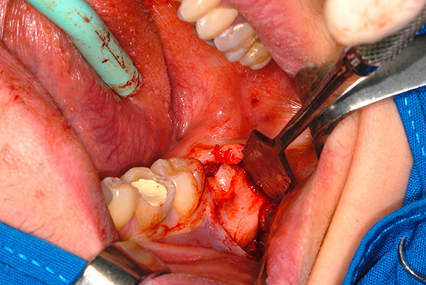 A volte il prezzo di rimozione dei denti del giudizio complessi può arrivare fino a 15-25 mila rubli (a seconda del livello della clinica, della complessità del caso clinico e di alcuni altri fattori).