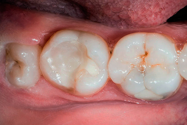 A sinistra è un dente del giudizio semi-rinforzato (cioè parzialmente nascosto sotto la gomma).