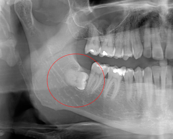 Trattenimento del dente del giudizio - i prezzi per la rimozione di tali denti sono generalmente i più alti.