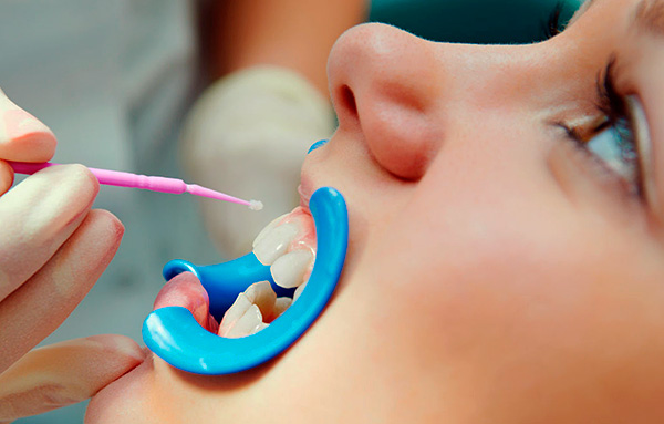 Con la fluorurazione dello smalto, diventa più resistente agli acidi.