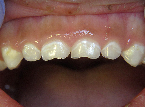 Carie cariate sui denti da latte