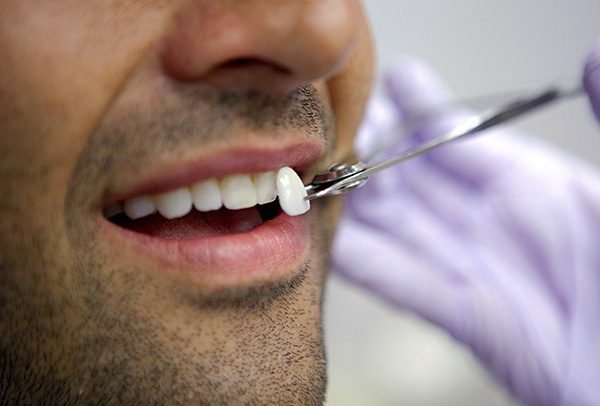 Le faccette sono un rivestimento sottile (ad esempio, in ceramica), che può migliorare significativamente l'aspetto dei denti problematici.