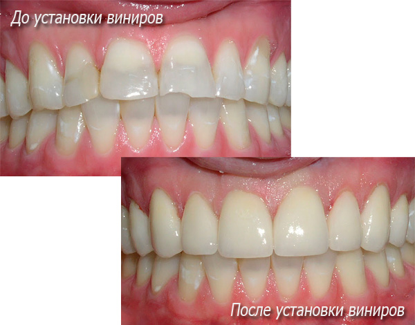 La foto mostra le condizioni dei denti del paziente prima e dopo l'installazione delle faccette ...