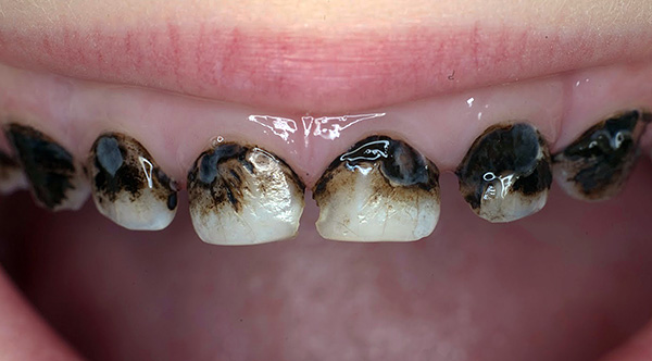 La foto mostra i denti da latte argentati di un bambino.