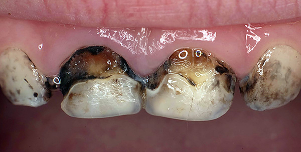 Spesso l'argentatura dei denti non influisce in modo significativo sull'ulteriore sviluppo del processo cariato.