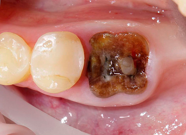 Parleremo della procedura per rimuovere le radici dei denti e alcune delle difficoltà che accompagnano tali manipolazioni ...