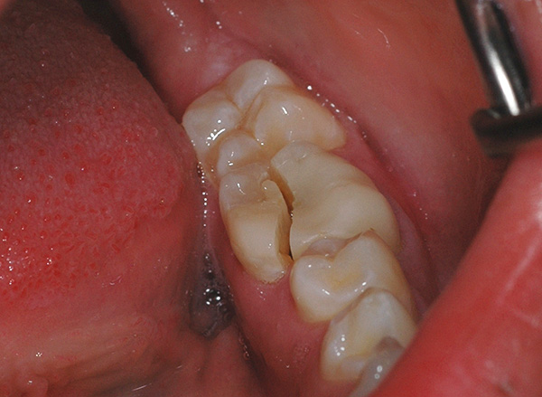 Un altro esempio di frattura di un dente molto fallita, quando molto probabilmente è necessario separarsene.