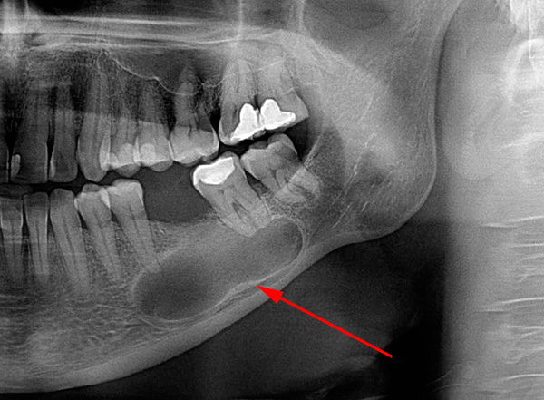 La foto mostra un esempio di un'enorme cisti, che cattura già le radici di due denti contemporaneamente.