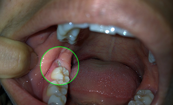 In alcuni casi, i denti del giudizio possono essere utili per protesi rimovibili o non rimovibili, quindi non affrettarti a rimuoverle senza necessità inutili.
