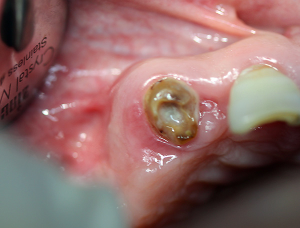 Può sembrare che afferrare una tale radice di un dente danneggiato con una pinza sia abbastanza problematico, sebbene in pratica ciò non sia spesso difficile.