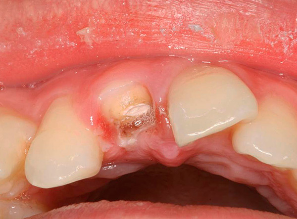 La radice di un dente così gravemente danneggiato deve essere rimossa.