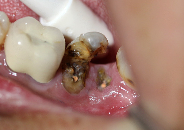 Nei pazienti di età avanzata, la rimozione delle radici dei denti cariati, di regola, non presenta grandi difficoltà.