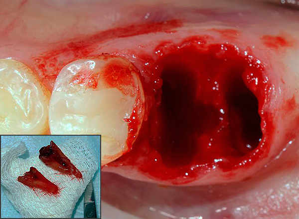 Se il medico non ha rimosso completamente il dente, è meglio cercare un aiuto ripetuto in modo che il foro sia in definitiva privo di inclusioni indesiderate.
