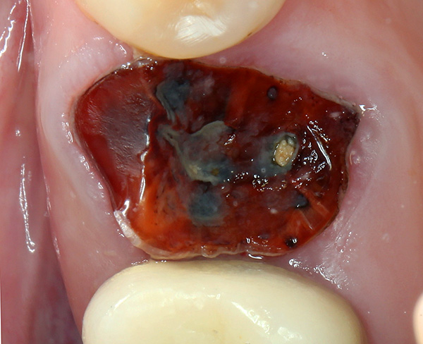 Le radici dei denti marci devono essere rimosse senza fallo, e prima viene fatto, meglio è.