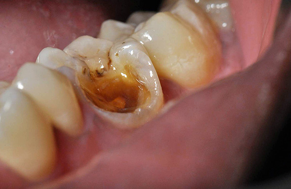 Se un pezzo, anche se grande, si stacca dal dente, ciò non significa che devi separarti dal dente.