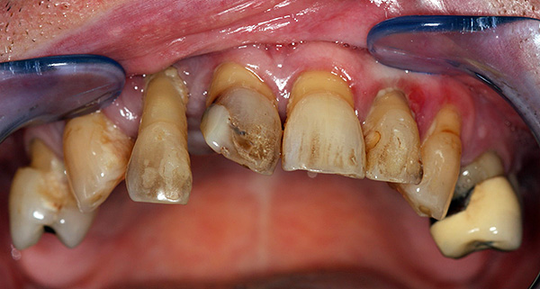 Outro exemplo da condição dos dentes na mandíbula superior antes do tratamento ...