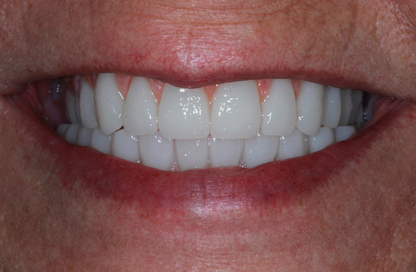 Em geral, podemos dizer que as próteses dentárias usando todas as quatro tecnologias são um prazer bastante caro.