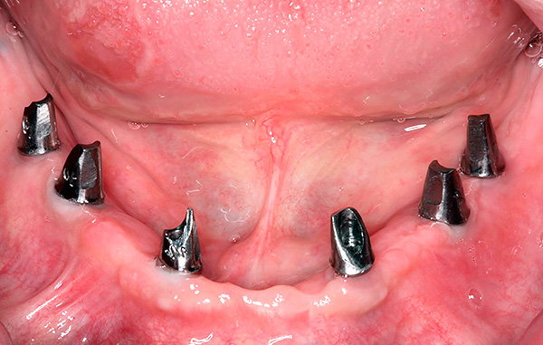Quando próteses usando a tecnologia All-on-6, 6 implantes são usados.