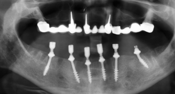 Os implantes basais são fixados em uma camada densa de osso, portanto sua estabilidade primária é muito alta.