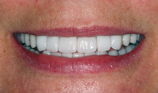 Apesar da tecnologia de restauração dentária All-on-4 permitir restaurar rapidamente a estética e a capacidade de mastigar alimentos, nem toda clínica poderá encontrar um implantologista que conheça essa técnica.