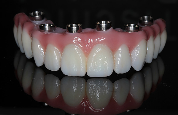 Dentadura (All-on-6)