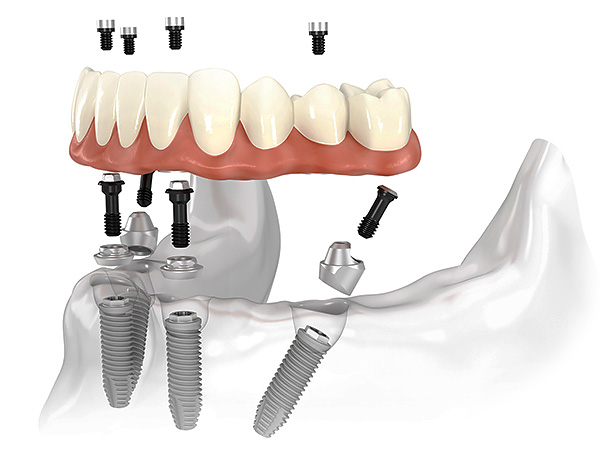 A figura ilustra esquematicamente o conceito da tecnologia de próteses dentárias All-on-4.