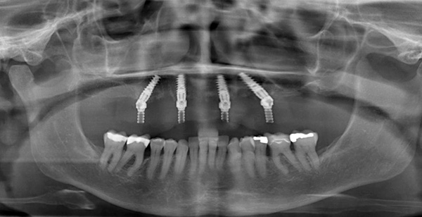 A imagem mostra que dois implantes são fixados verticalmente e dois - em ângulo.