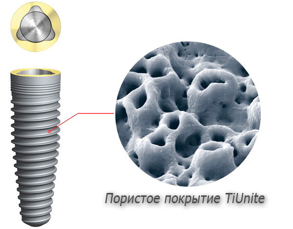 A superfície dos implantes de titânio possui um revestimento poroso especial que facilita o processo de fusão do implante com o tecido ósseo.