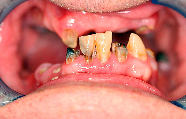 A foto mostra a condição dos dentes do paciente antes da prótese.