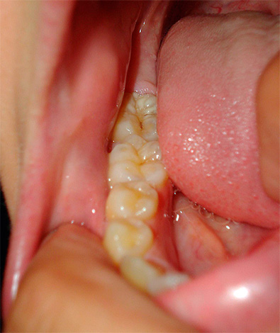 Com um resultado bem-sucedido de medidas terapêuticas, o cisto se resolve e o dente pode durar muitos mais anos.