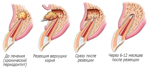 O esquema de ressecção do ápice da raiz do dente