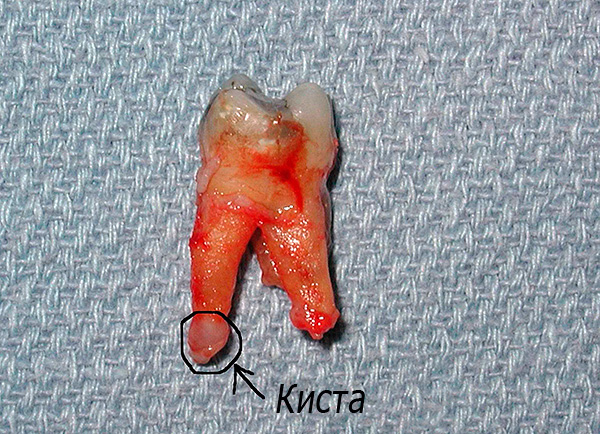 Freqüentemente, é aconselhável remover imediatamente o dente, em vez de realizar seu tratamento a longo prazo com um resultado muito duvidoso.