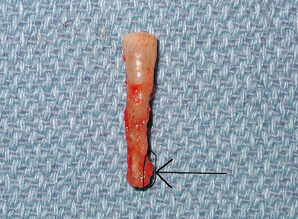 Acontece também que, após muitos meses de tratamento, um dente com cisto ainda precisa ser removido.