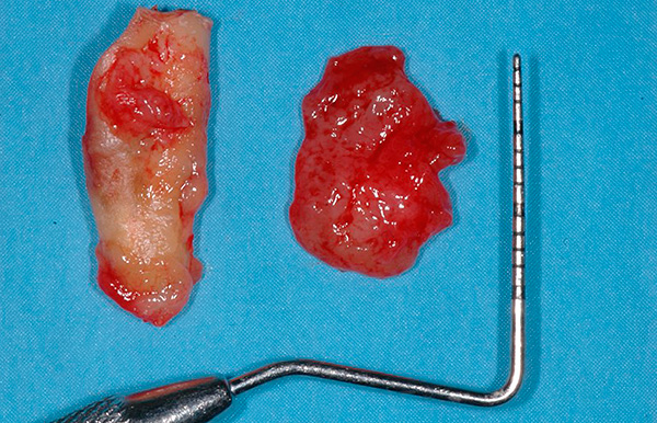 A fotografia mostra um cisto dentário removido.