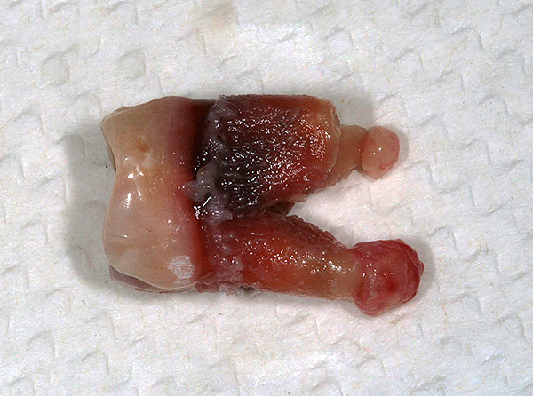 Um dente removido, cujas raízes são claramente visíveis.