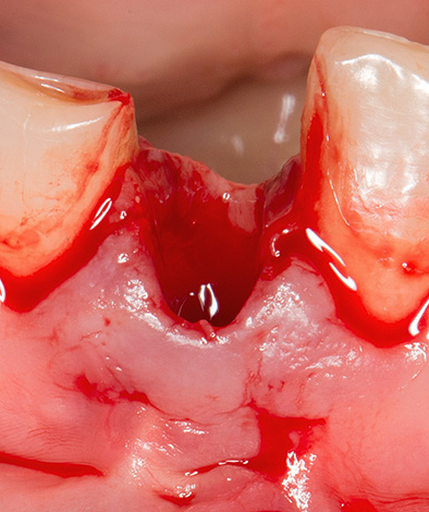 No buraco cheio de sangue, o médico pode não considerar os fragmentos esquerdos do dente e os restos do cisto.