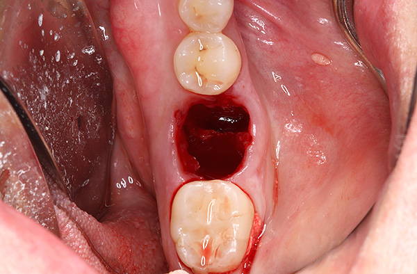 Às vezes, em tal buraco, existe até um fragmento da raiz do dente junto com todo o cisto.