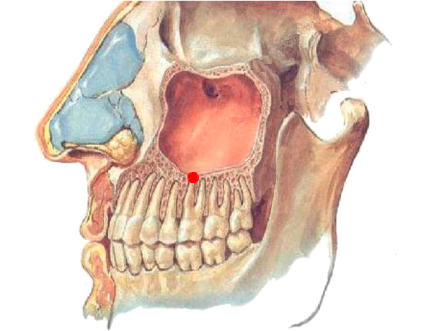 Um cisto nas raízes dos dentes superiores pode crescer no seio maxilar.